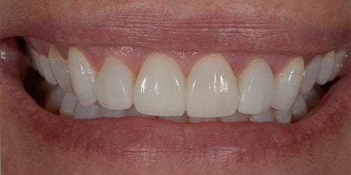 Invisalign - Marci - After